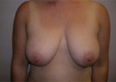 Patient # 94634 Before Photo # 1