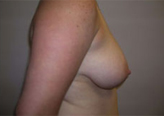 Patient # 94634 Before Photo # 3