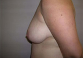 Patient # 94634 Before Photo # 5