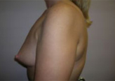Patient # 60253 Before Photo # 3