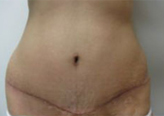 Patient # 76974 After Photo # 2