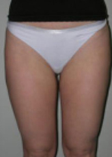 Patient # 50479 After Photo # 2