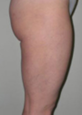 Patient # 50479 After Photo # 4