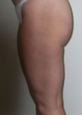 Patient # 50479 After Photo # 6
