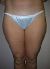 Patient # 50479 Before Photo # 1