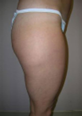 Patient # 50479 Before Photo # 3