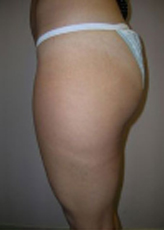 Patient # 50479 Before Photo # 5