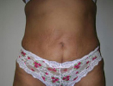 Patient # 46730 After Photo # 2