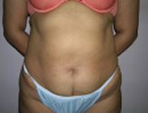 Patient # 46730 Before Photo # 1