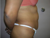Patient # 46730 Before Photo # 5