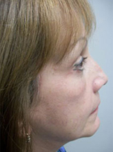 Patient # 24670 After Photo # 4