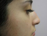 Patient # 41835 Before Photo # 5