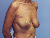 Patient # 95785 Before Photo # 3