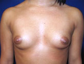 Patient # 32731 Before Photo # 1