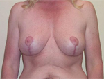 Patient # 22081 After Photo # 2