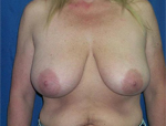 Patient # 22081 Before Photo # 1