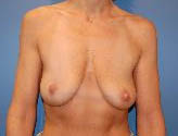 Patient # 52541 Before Photo # 1