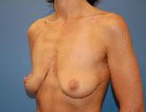 Patient # 52541 Before Photo # 3