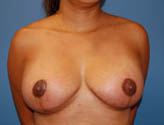 Patient # 39067 After Photo # 2