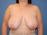 Patient # 29688 Before Photo # 1