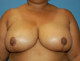 Patient # 40750 After Photo # 2