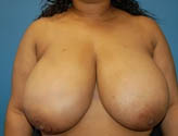 Patient # 40750 Before Photo # 1