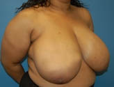 Patient # 40750 Before Photo # 3