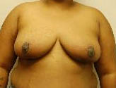 Patient # 45343 After Photo # 2