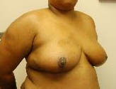 Patient # 45343 After Photo # 4