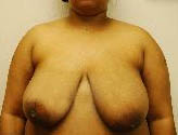 Patient # 45343 Before Photo # 1