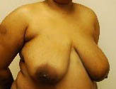 Patient # 45343 Before Photo # 3