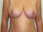 Patient # 96186 After Photo # 2