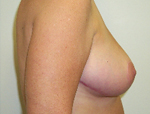 Patient # 96186 After Photo # 4