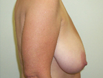 Patient # 96186 Before Photo # 3