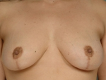 Patient # 77075 After Photo # 2