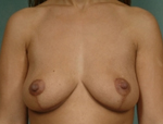Patient # 39332 After Photo # 2