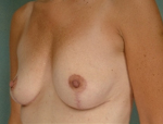 Patient # 26660 After Photo # 4