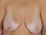 Patient # 18109 Before Photo # 1
