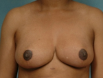 Patient # 88525 After Photo # 2