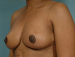 Patient # 88525 After Photo # 4