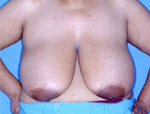 Patient # 29992 Before Photo # 1