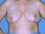 Patient # 31518 After Photo # 2
