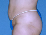 Patient # 21920 After Photo # 2