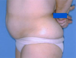 Patient # 21920 Before Photo # 1