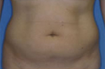 Patient # 90409 Before Photo # 1